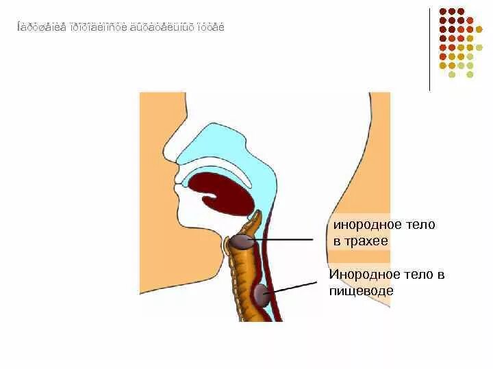 Первая помощь при попадании в глотку. Инородные тела гортани и трахеи. Попадание инородного тела в гортань. Инородные тела дыхательных путей трахеи.