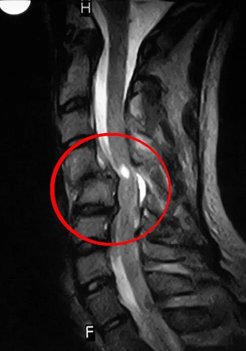 Посттравматическая миелопатия спинного мозга мрт. Посттравматическая миелопатия шейного отдела. Посттравматическая миелопатия шейного отдела мрт. Разрыв спинного мозга мрт.