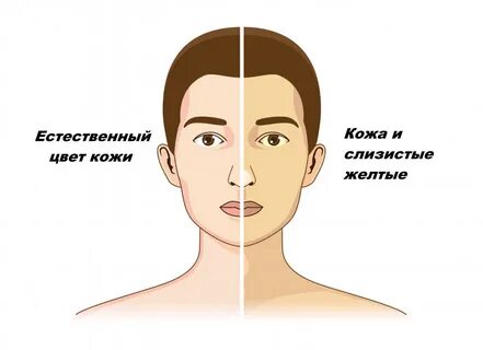 Jaundice перевод