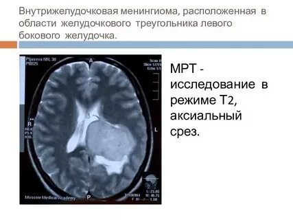 Менингиома в голове что это такое