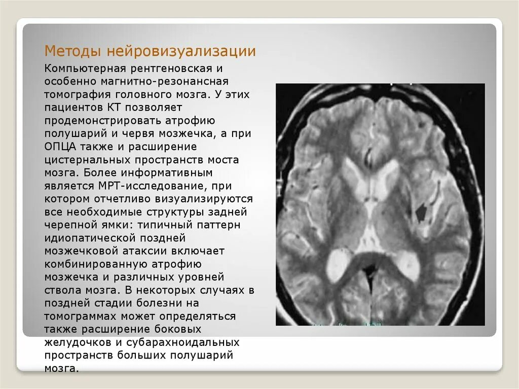 Атрофические изменения мозжечка на мрт. Нейровизуализация мрт. Мозжечковая атаксия на кт. Атрофия червя мозжечка кт. Мозжечковая опухоль