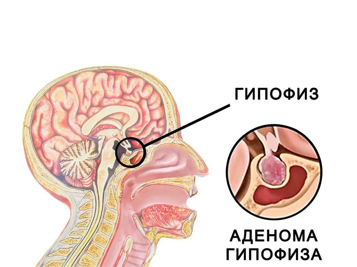 Изменения гипофизе. Аденома гипофиза рентген. Микроаденома гипофиза мкб 10. Аденома паразитов железы. Фото как расположена аденома у мужчин.