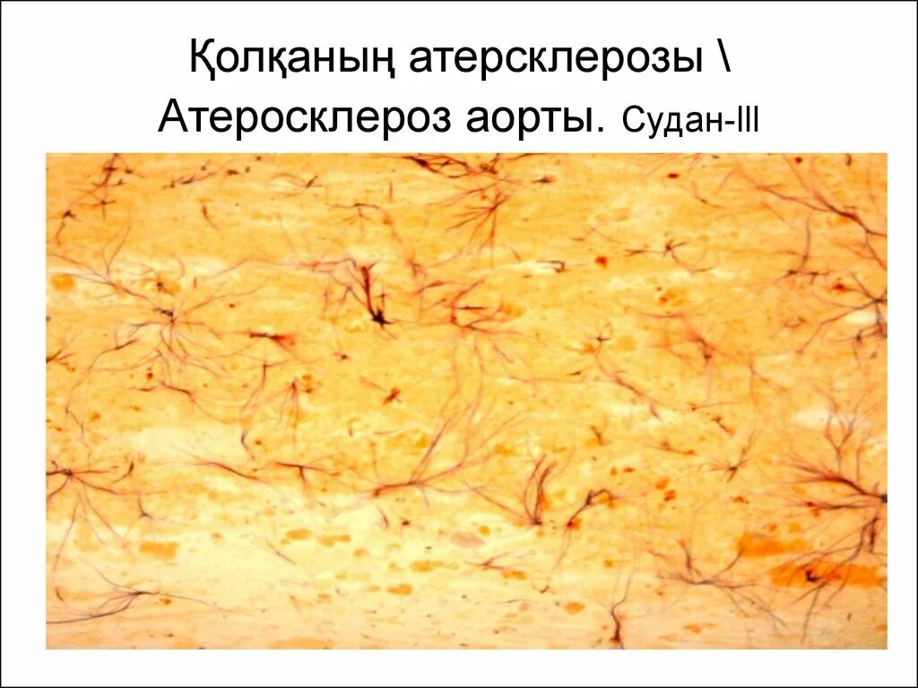Атеросклероз аорты препарат. Атеросклероз аорты микропрепарат судан 3. атеросклероз аорты (окраска суданом iii). атеросклероз аорты окраска суданом 3 микропрепарат. атеросклероз аорты микропрепарат судан.