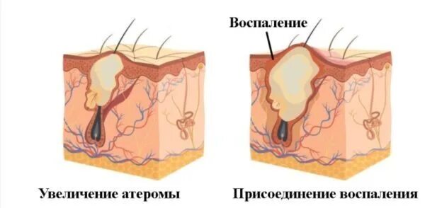 Как устранить воспаление. Атерома воспаление сальной железы. кисты / атеромы сальных желез. абсцедирующий фурункул.