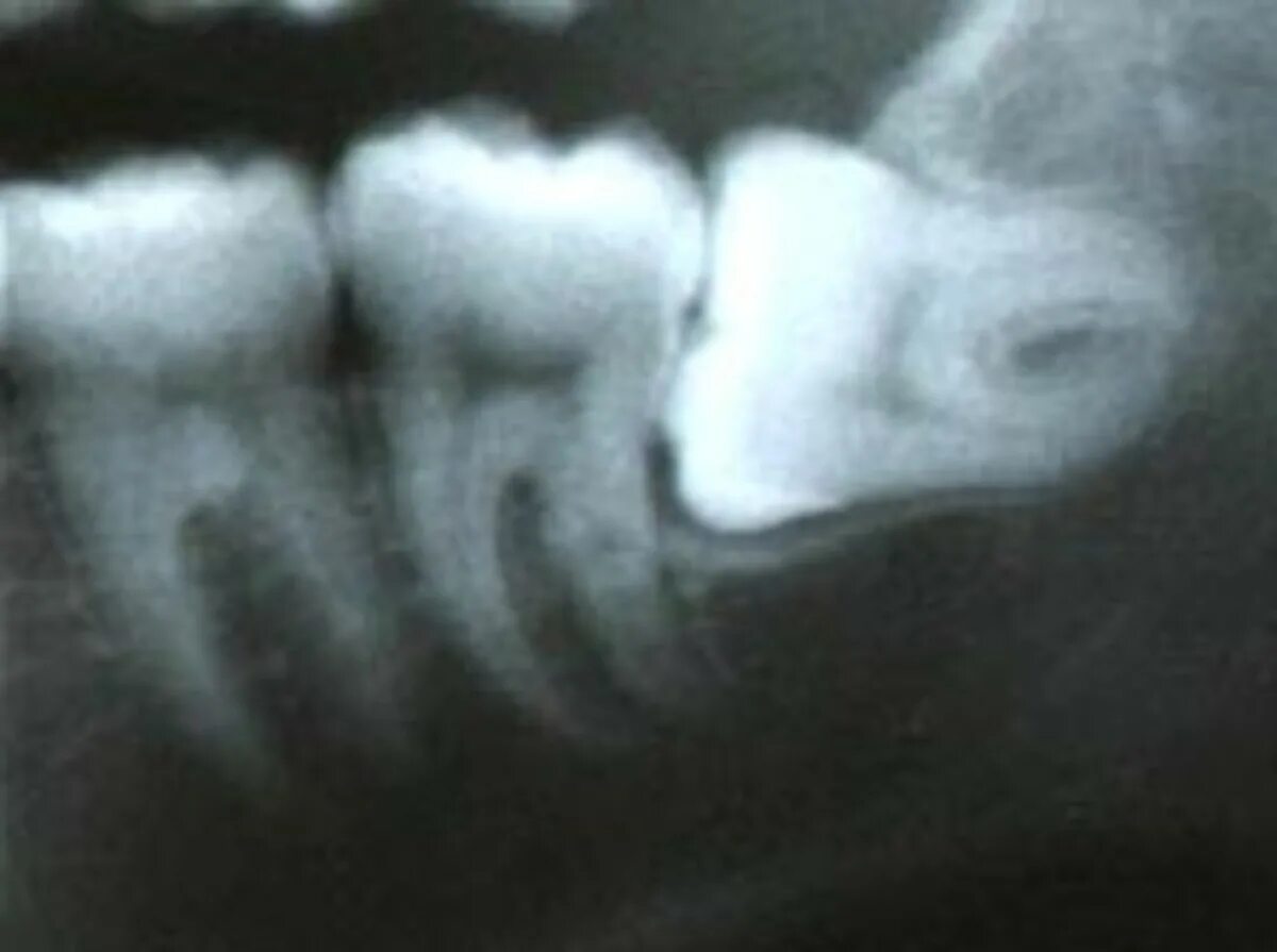 Лечат 8 зуб. Рентген восьмерки зуб мудрости. Зуб мудрости на рентгене горизонтально. Кривой зуб мудрости рентген. Ретинированный зуб 8 ка.