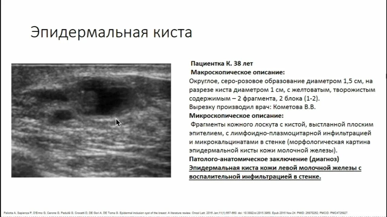 Эпидермальная киста на УЗИ. Железы кистозно расширены