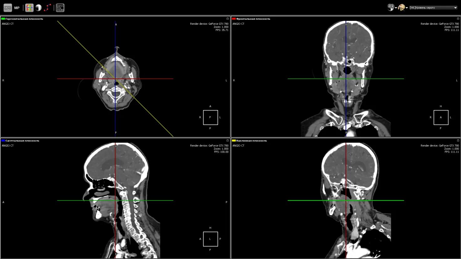 MPR реконструкция кт. Мультипланарная реконструкция (MPR). Мультипланарная реконструкция мрт. Плоскости в компьютерной томографии.