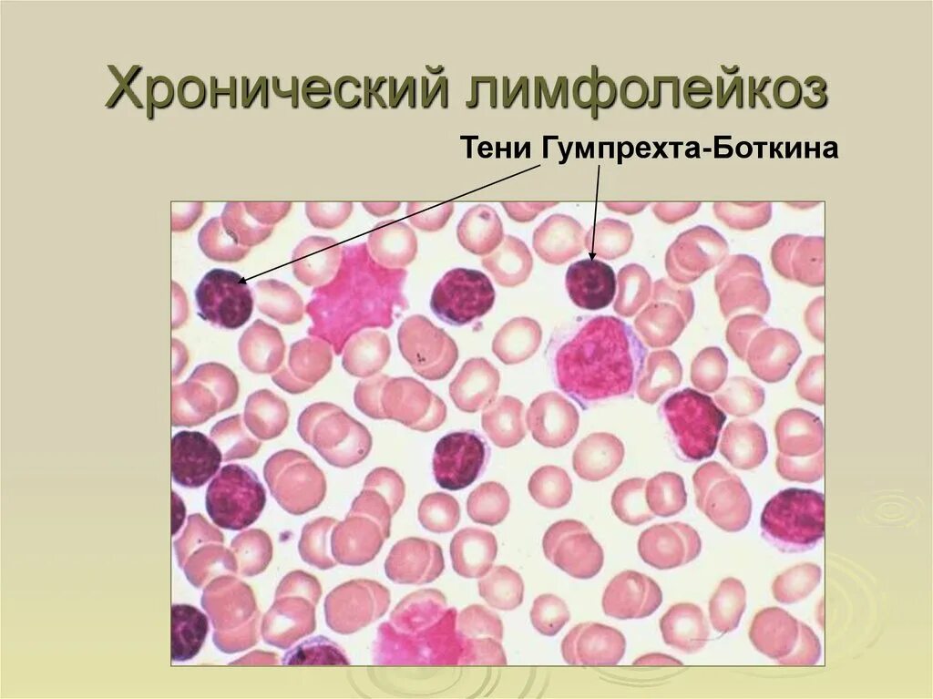 Клетки лейколиза (тени Боткина-Гумпрехта). Тени Боткина Гумпрехта. Тени Боткина-Гумпрехта при хроническом лимфолейкозе это. Клетки Боткина Гумпрехта это. Хронический лимфолейкоз кровь