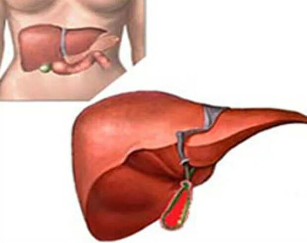 Калькулезный холецистит. Печеночный холецистит.