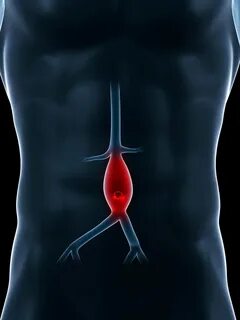 Abdominal aneurysm