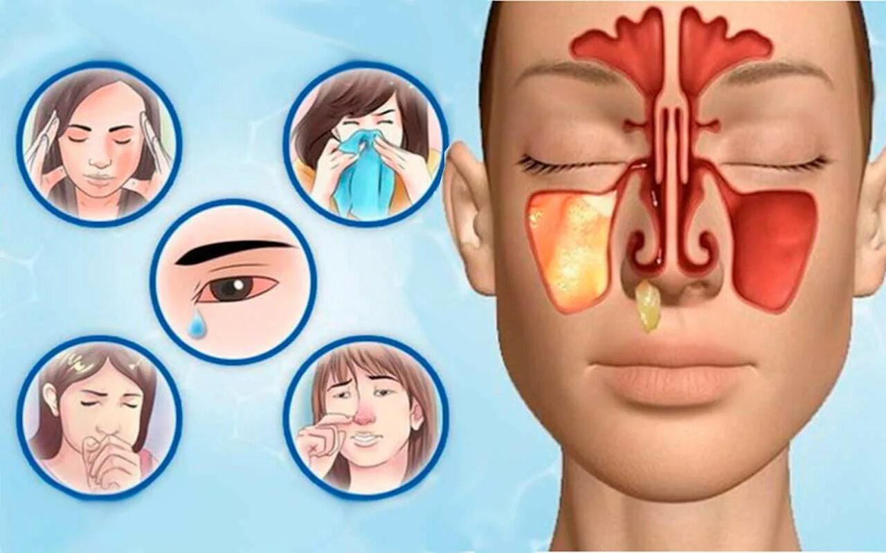 Греть ли нос при заложенности носа. Гайморовы пазухи гайморит. Гайморовы пазухи гайморит хронический. Клиника острого одонтогенного синусита.