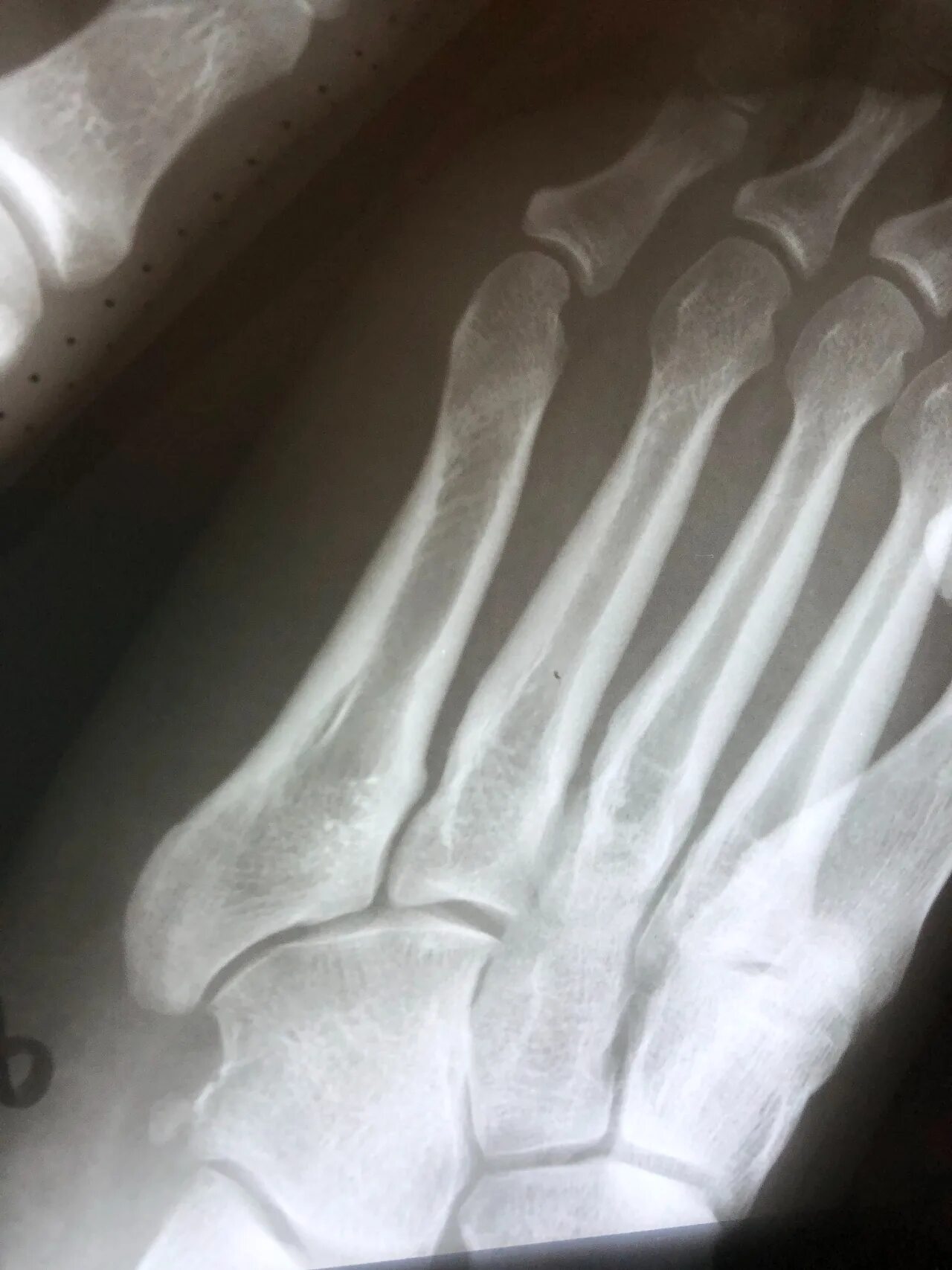 Figure 1 from Unusual Variant of the Nutcracker Fracture of the Calcaneus and Ta