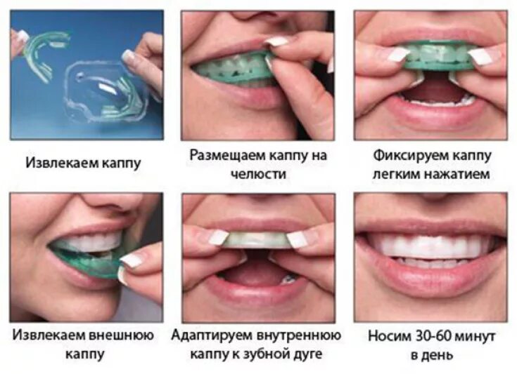 Капа как использовать. Капа для зубов стоматологическая. Капа для выравнивания челюсти. Капа для домашнего отбеливания зубов. Капы для зубов для геля.