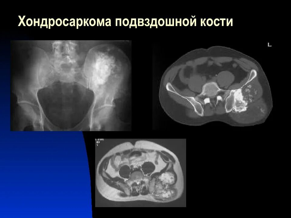 Образование подвздошной кости. Хондросаркома подвздошной кости на кт. Хондросаркома бедренной кости кт. Гигантоклеточная опухоль бедренной кости на кт. Остеосаркома подвздошной кости на кт.