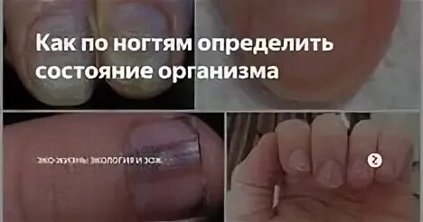 Как понять состояние. По цвету ногтей определить состояние организма. как определить состояние организма по ногтям. как определить жизнь по ногтям.