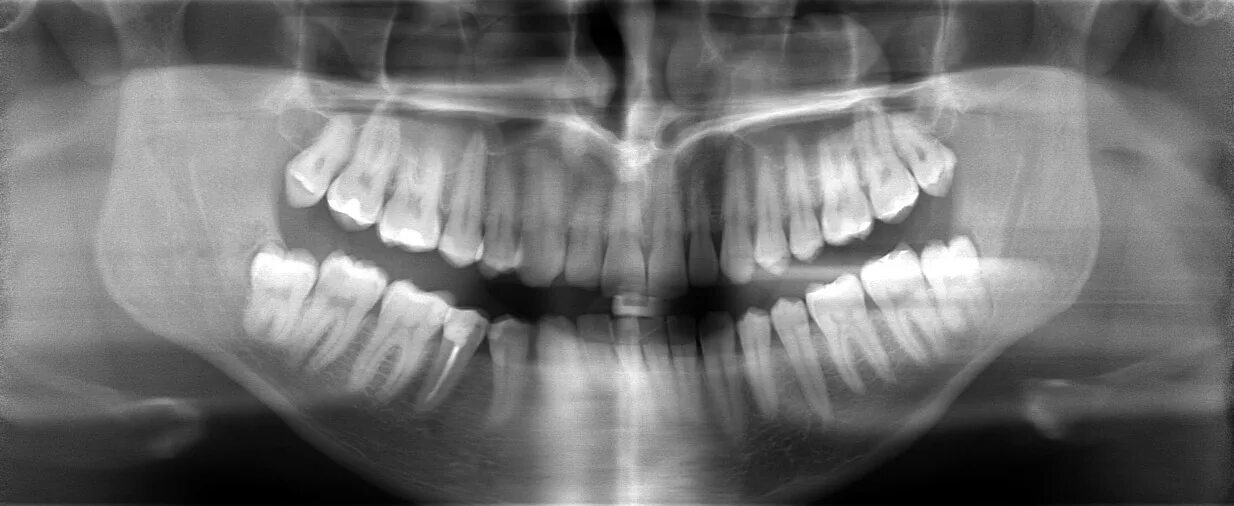 Снимок зубов видное. Ретинированный зуб мудрости рентген. Ортопантомограмма кариес.