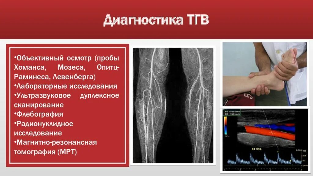 Тромбофлебит диагностика. Тромбоз глубоких вен клиника. Тромбоз глубоких вен лабораторная диагностика. Диагноз тромб