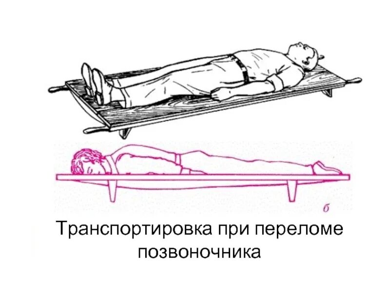 Транспортировка пострадавших с переломом позвоночника осуществляется. Пмп при травме позвоночника транспортировка. Транспортировка при переломе поясничного отдела позвоночника. Доврачебная помощь при повреждении костей таза. Переломы позвоночника первая помощь транспортная иммобилизация.