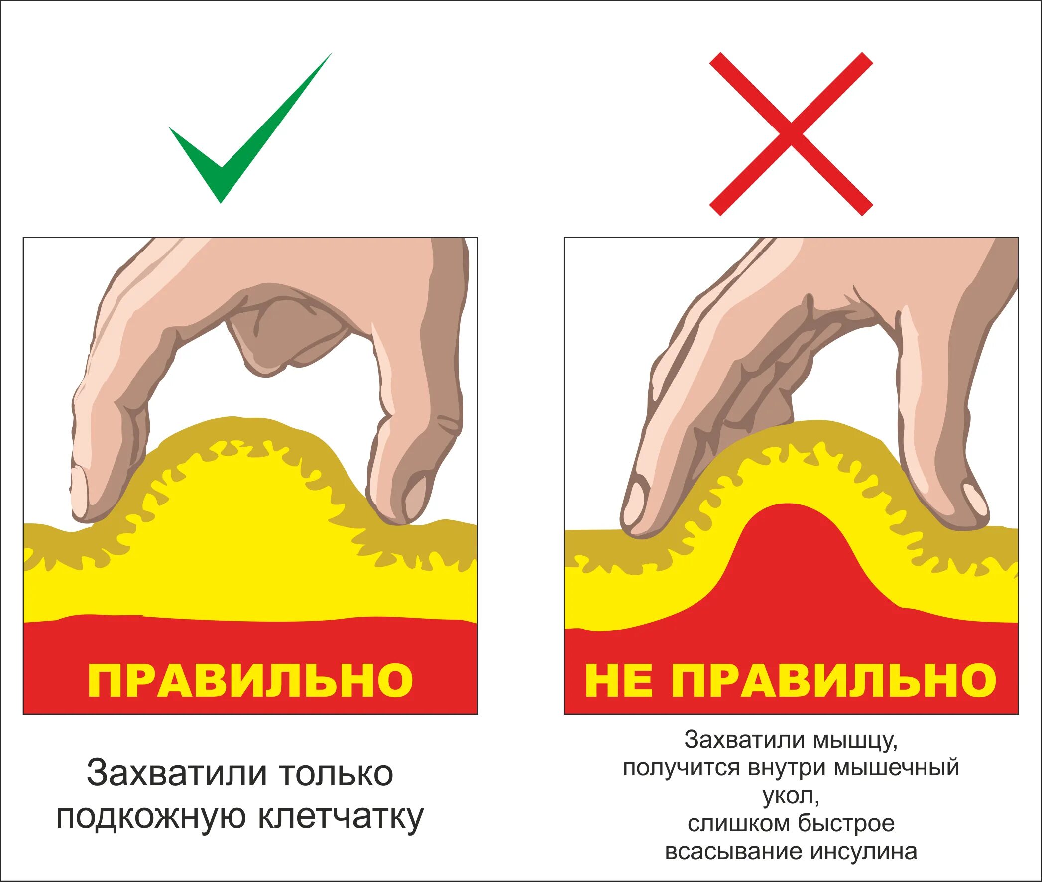 Почему после укола инсулина. Подкожная инъекция инсулина алгоритм. Алгоритм проведения подкожного введения инсулина. Алгоритм введения подкожной инъекции инсулина. Обработка места инъекции инсулином.