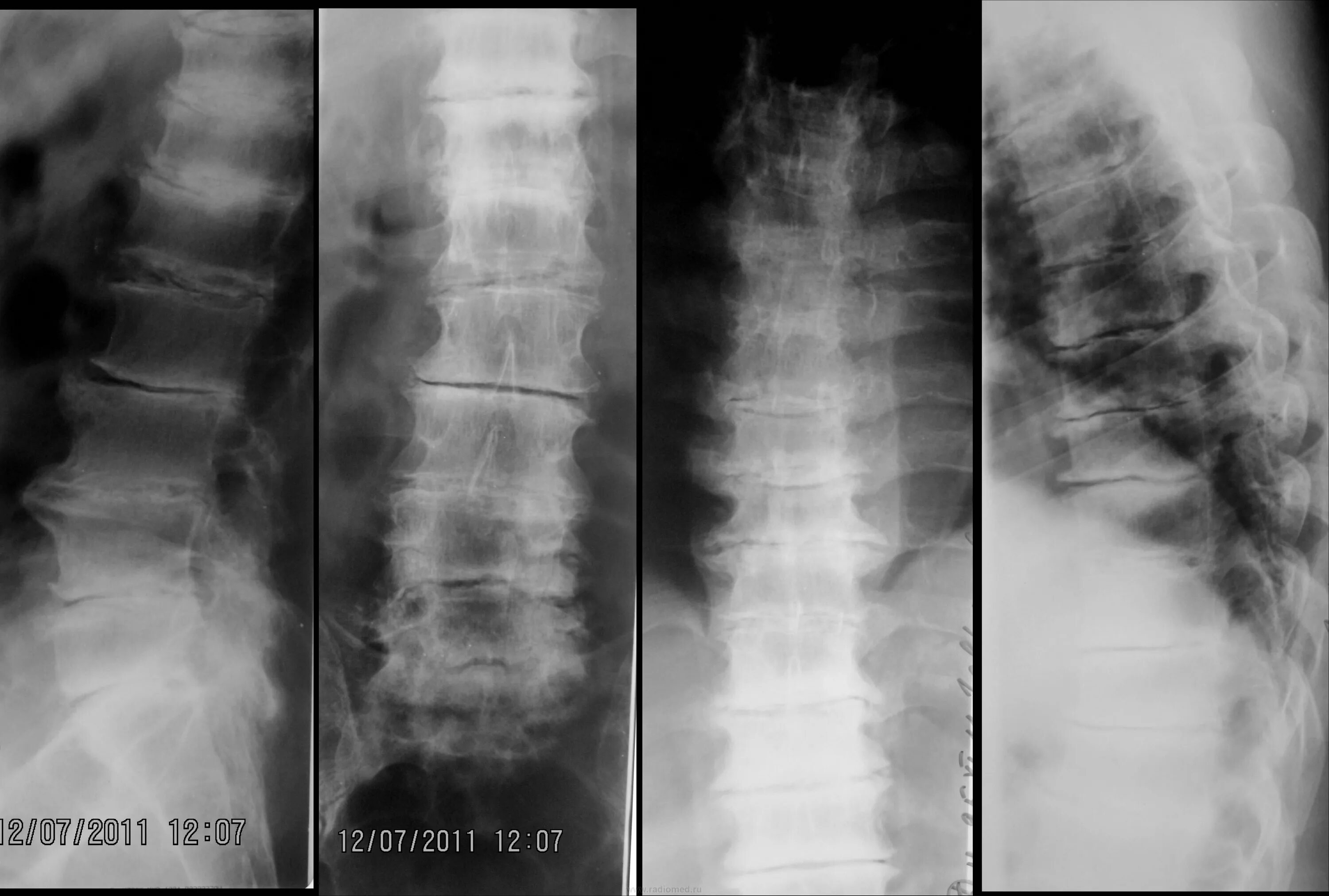 Остеохондроз с7
