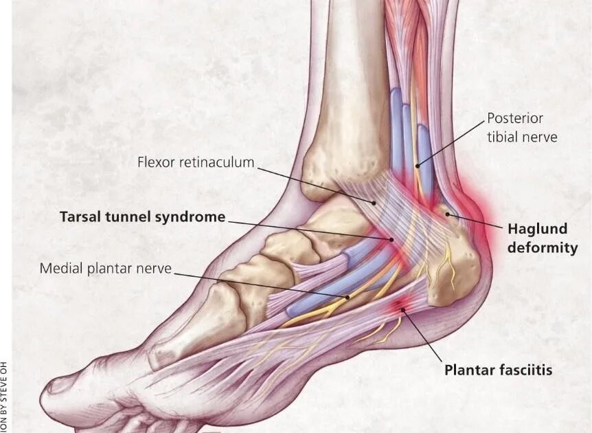 Голеностопный сустав это. Синдром тарзального канала стопы. Туннельный синдром голеностопа. Тарзальный туннельный синдром стопы. Синдром тарзального канала медиальная лодыжка.