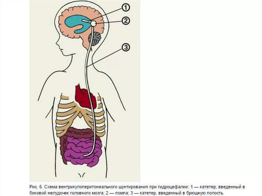 Вентрикулоперитонеальный шунт схема. Шунт головного мозга при гидроцефалии. Операция вентрикулоперитонеальное шунтирование. Вентрикуло-перитонеальное шунтирование головного мозга.