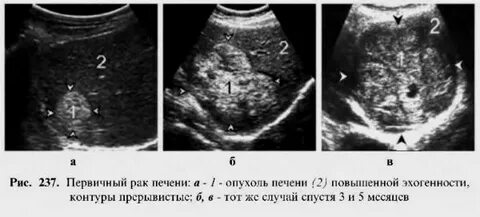 2 опухоли в печени