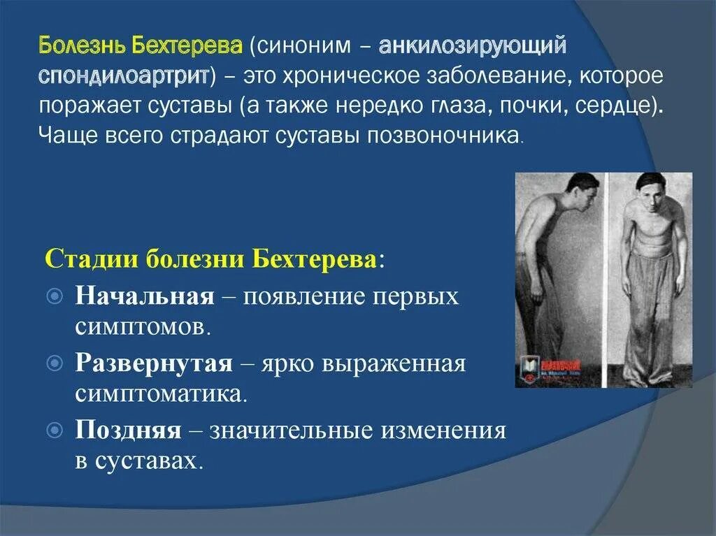 Болезнь бехтерев симптомы. Болезнь бехтерева пропедевтика внутренних болезней. болезнь бехтерева симптомы. бехтерева болезнь бехтерева. болезнь бехтерева диагноз.