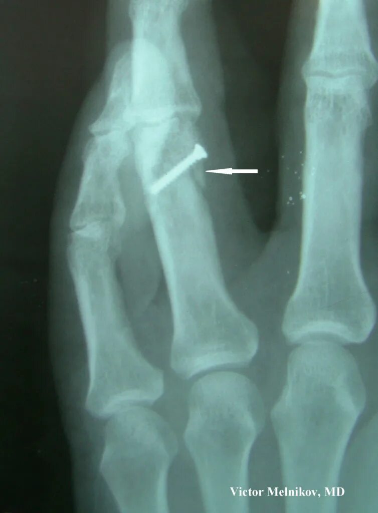 краевой перелом кисти. перелом 5 плюсневой кости кисти. оскольчатый перелом ногтевой фаланги рентген. оскольчатый перелом основной фаланги 1 пальца. краевой перелом кисти.