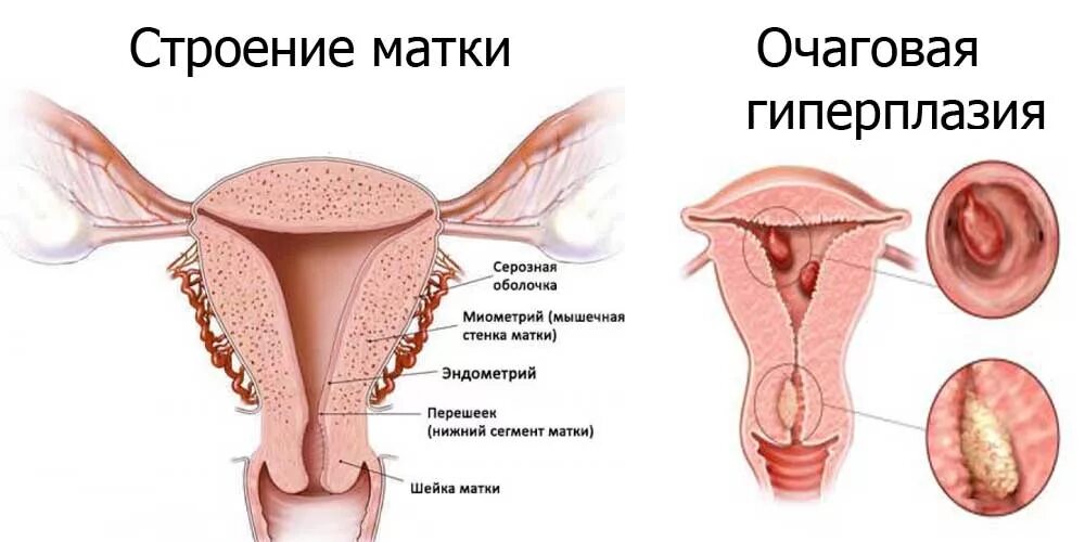 Эндометрия разрастается. Очаговая гиперплазия эндометрия матки что это. Разрастание слизистой матки. Очаговая гиперплазия эндометрит. Очаговая гиперплазия эндометрия полипа.