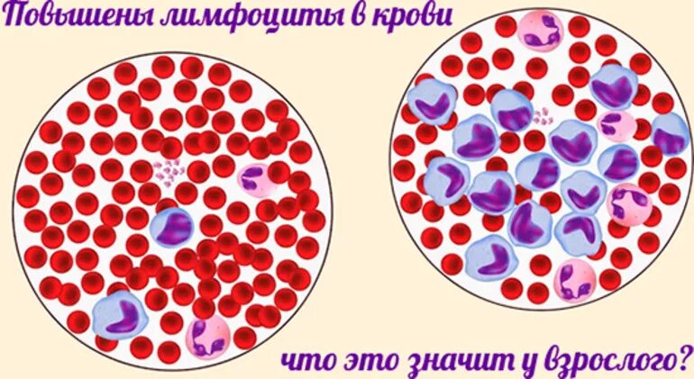 Лимфоциты в крови. Лимфоциты повышены. Повышены лимфоциты в крови. Увеличены лимфоциты в крови у взрослого что это значит. Лимфоциты в крови 50 у мужчин