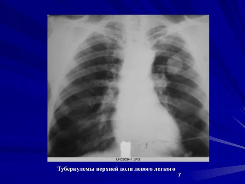 Рентген туберкулез туберкулема. Туберкулёма фаза инфильтрации. Туберкулема верхней доли. Образование верхней доли левого легкого