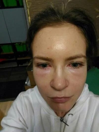 Синяки и отеки после блефаропластики
