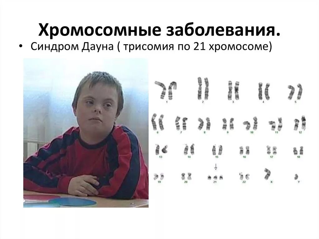 Синдром Дауна трисомия 21 хромосомы. Синдром Дауна (трисомия по 21-й хромосоме) симптомы. Синдром Дауна трисомия по 21 хромосоме. Синдром Дауна (трисомия по 21 паре хромосом). Наличие лишней хромосомы