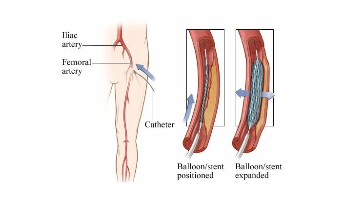 Баллонная ангиопластика и стентирование нижних конечностей. Ангиопластика сосудов нижних конечностей. Стентирование сосудов конечностей. Шунтирование и стентирование артерий нижних конечностей. Тромбоз подвздошной вены