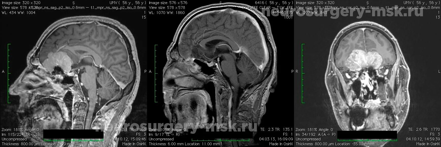 Опухоль головного мозга ольфакторной ямки. Менингиомы кавернозного синуса. Менингиома ольфакторной ямки кт. Менингиома головного мозга кт. После операции менингиомы головного мозга