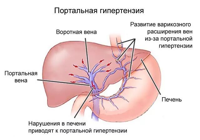 Гипертонии печень. Синдром воротная Вена. Портальная гипертензия и нижняя полая Вена. Сдавливание воротной вены. Воротная Вена портальная гипертензия.