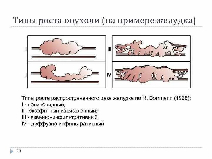 Диффузно инфильтративная. Экзофитный Тип роста опухоли желудка. Эндофитный Тип роста опухоли. Вид опухолей при различных формах роста. Каковы типы роста опухолей.