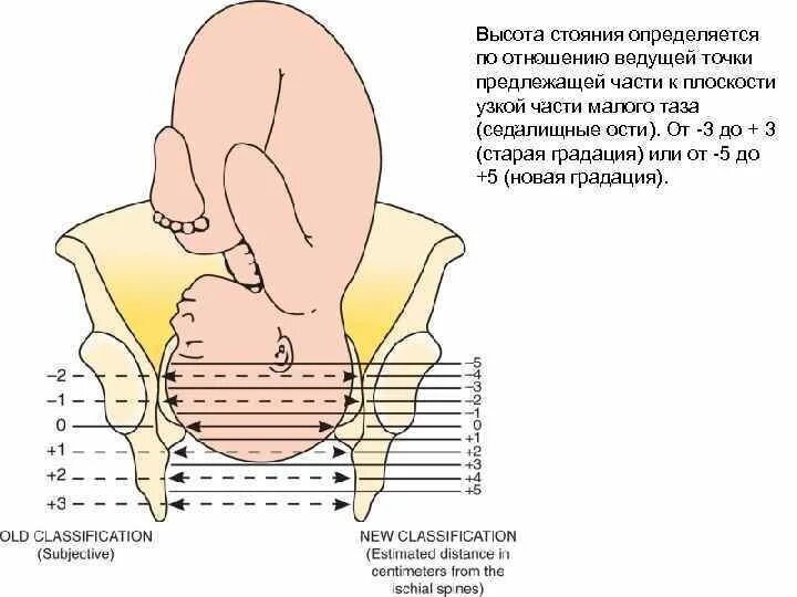 Головка малым сегментом во входе. Высота стояния головки плода. головка плода в полости малого таза. положение головки плода по отношению к плоскостям таза. головка плода в узкой части.
