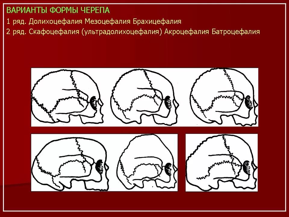 Черепная аномалия. Долихоцефалия черепа плода. Варианты формы черепа. Патологические формы черепа. Форма черепа в норме и при патологии.