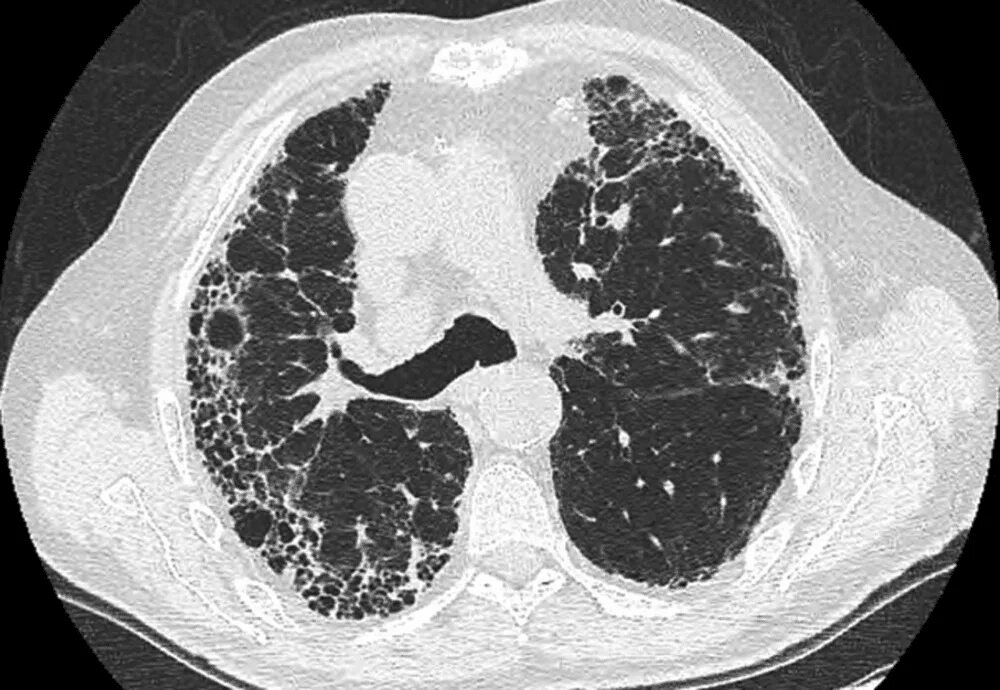 Субплевральные отделы легких. Идиопатический легочный фиброз кт. Идиопатический фиброз легких кт. Идиопатический пневмофиброз. Фиброз легкого на кт.