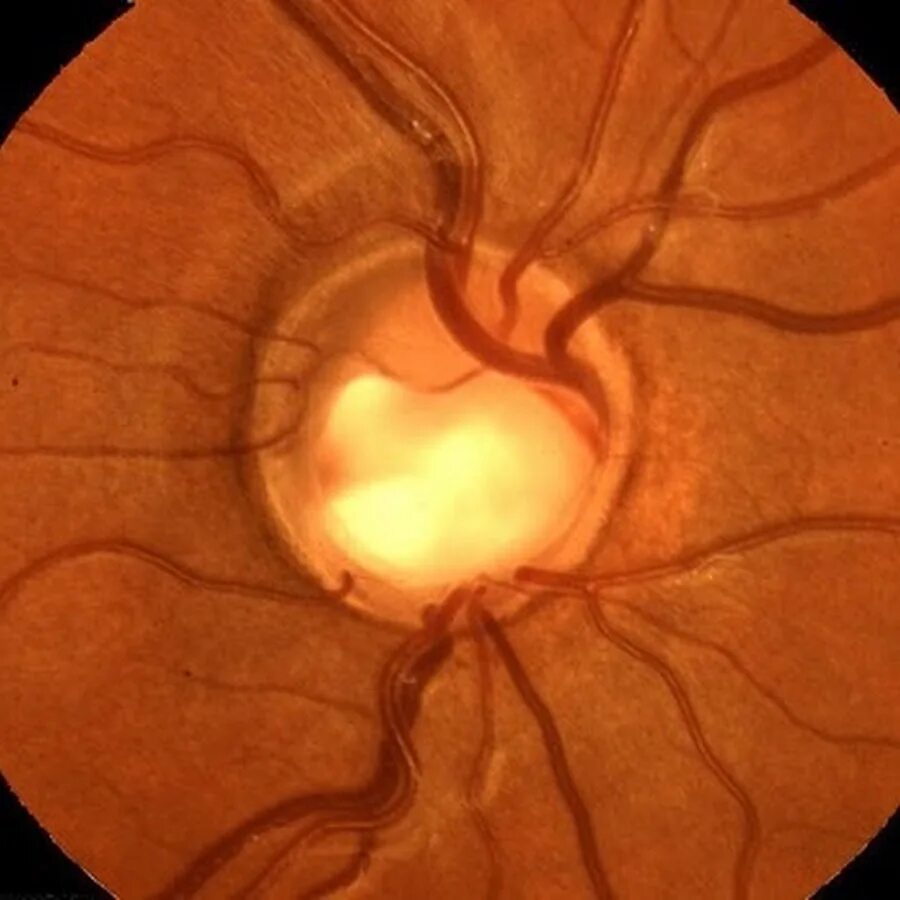 Зрительный нерв при глаукоме. Экскавация зрительного нерва при глаукоме. Глаукоматозная атрофия зрительного нерва.
