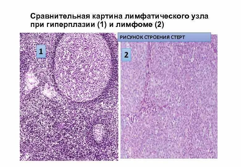 Гиперплазия лимфатического узла микропрепарат. Неспецифическая гиперплазия лимфатического узла микропрепарат. Реактивная фолликулярная гиперплазия лимфоузлов гистология. Лимфоидная ткань микропрепарат. Реактивная гиперплазия лимфоузла