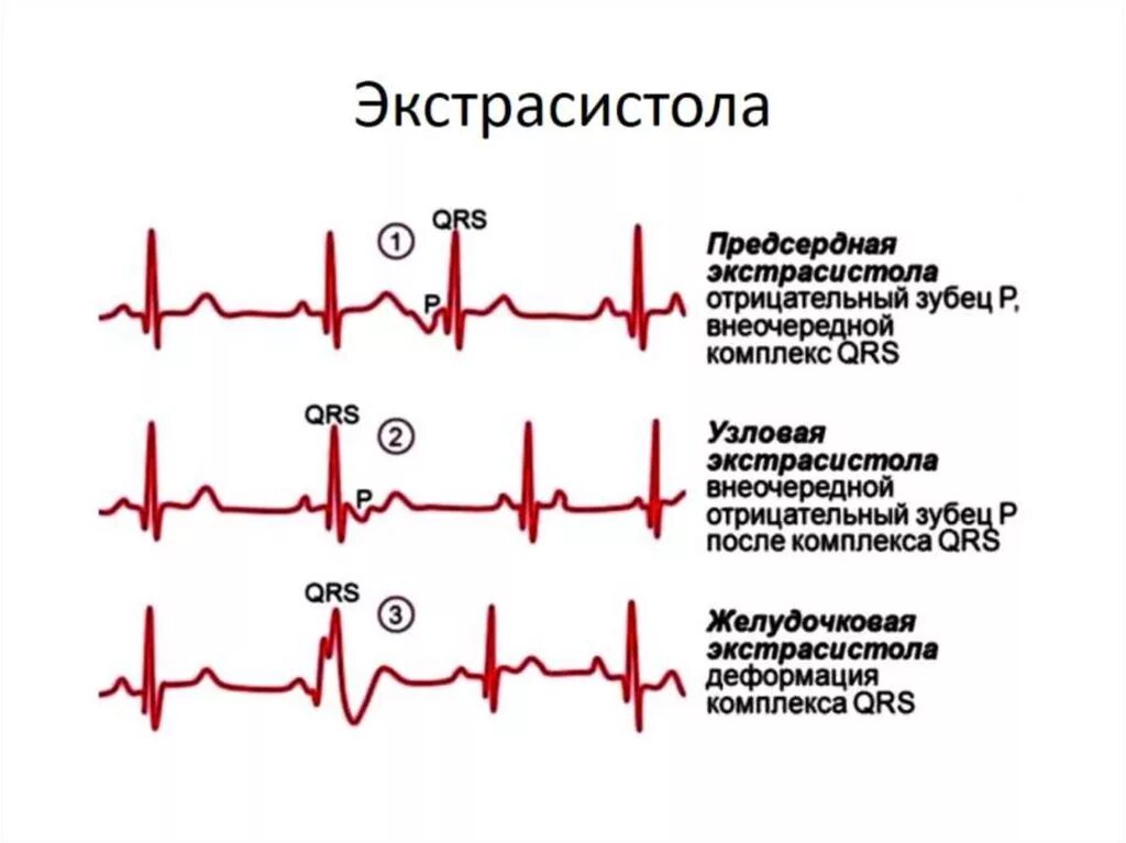 Экстрасистолы у женщин