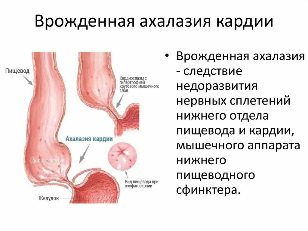 Ахалазия кардии это спазм. Симптомы ахалазии кардии. Симптомы ахалазии пищевода. Основной клинический симптом ахалазии кардии. Лечение расширение пищевода