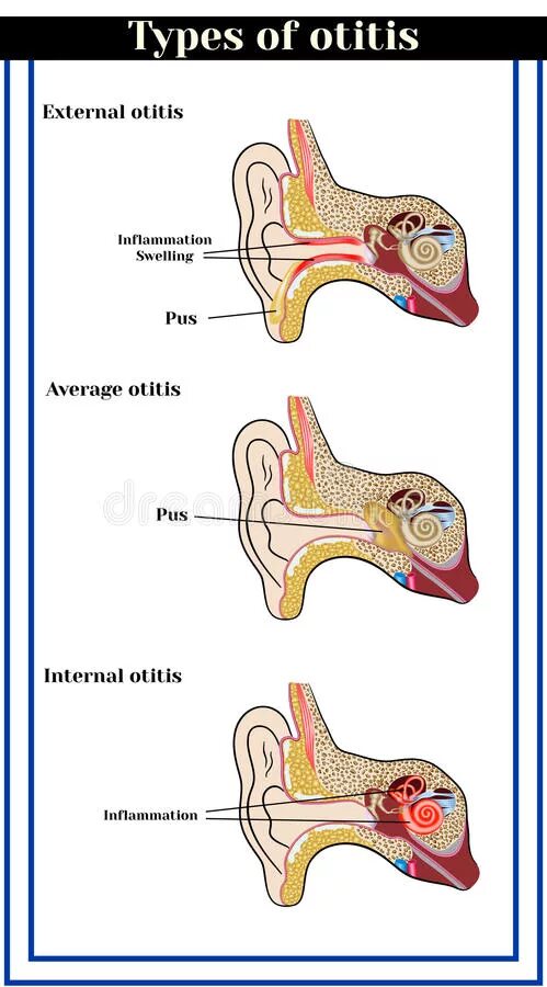 Шум среднего уха. Наружный средний внутренний отит.