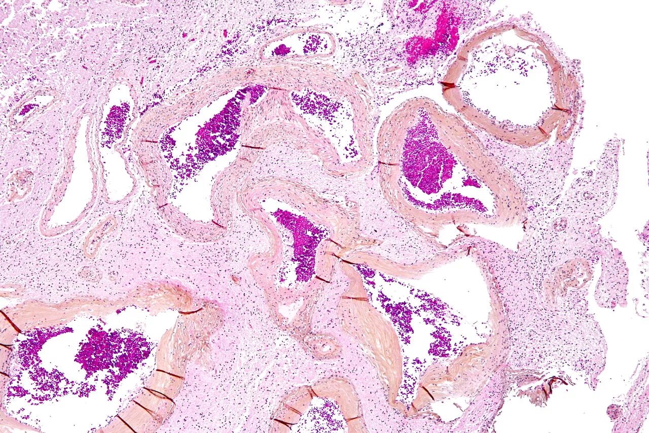 Сосудистая аномалия. Сосудистая мальформация головного мозга гистология. Мальформация сосудов мозга микропрепарат. Мальформация сосудов головного мозга гистология. Мальформация сосудов головного мозга микропрепарат.