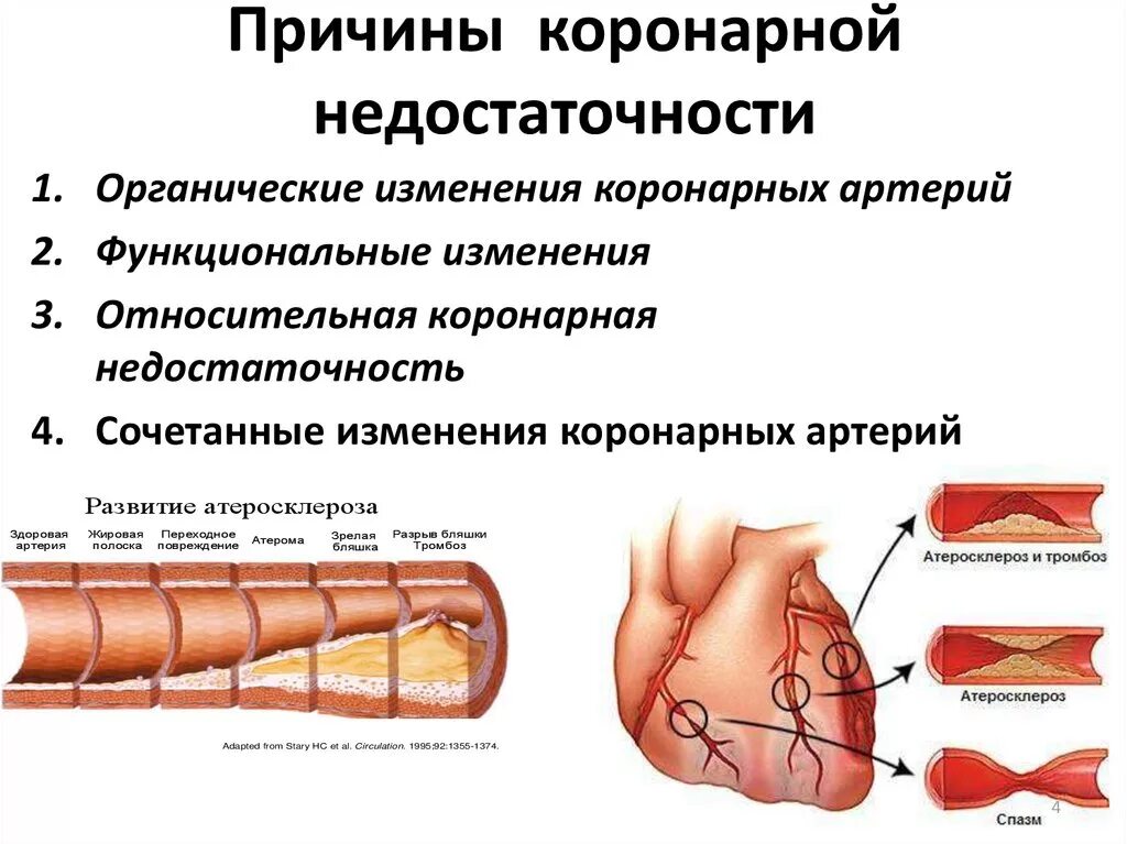 Острая сердечная коронарная недостаточность