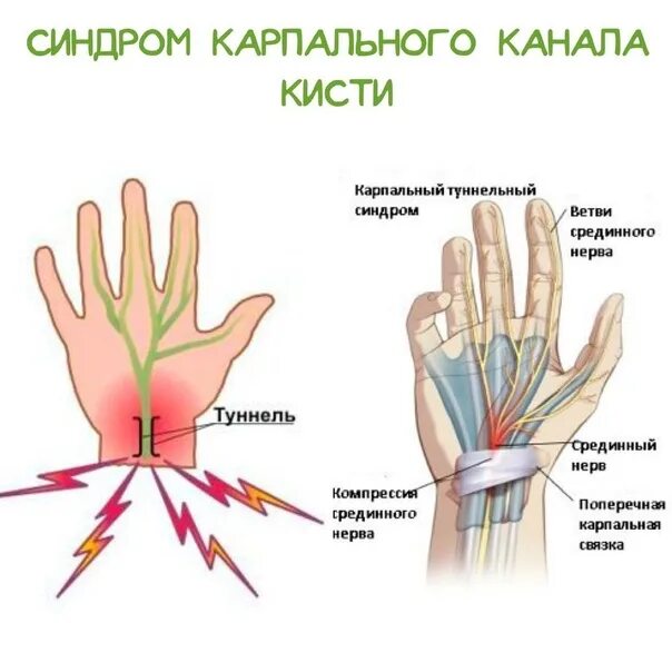 Туннельная нейропатия. Синдром карпального канала кисти. Карпальный туннельный синдром. Карпальный (запястный) туннельный синдром. Карпальный синдром лучезапястного сустава.