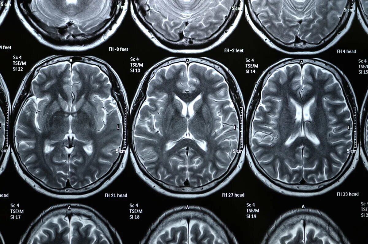 Снимок мрт головного мозга. Снимки мрт головного мозга. Мрт снимки мозга. Кт головного мозга снимки.